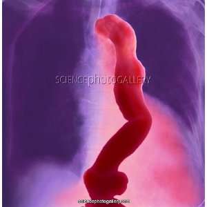 Aortic aneurysms, X ray Framed Prints 