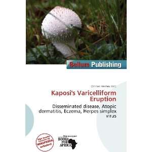   Kaposis Varicelliform Eruption (9786200742285) Othniel Hermes Books