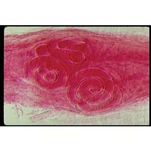 Trichinella spiralis Encysted Larvae, w.m. Microscope Slide  